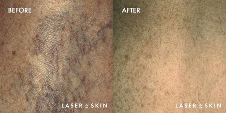 Treatments_AestheticDermatologySurgery-Sclerotherapy1.jpeg