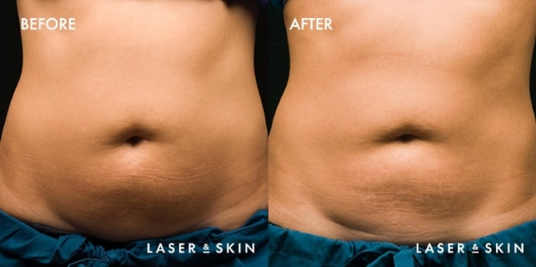 Treatments_BodyContouring-CoolSculpting4-2.jpeg