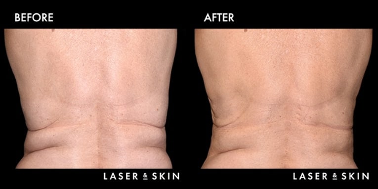 Treatments_BodyContouring-CoolSculpting5-2.jpeg