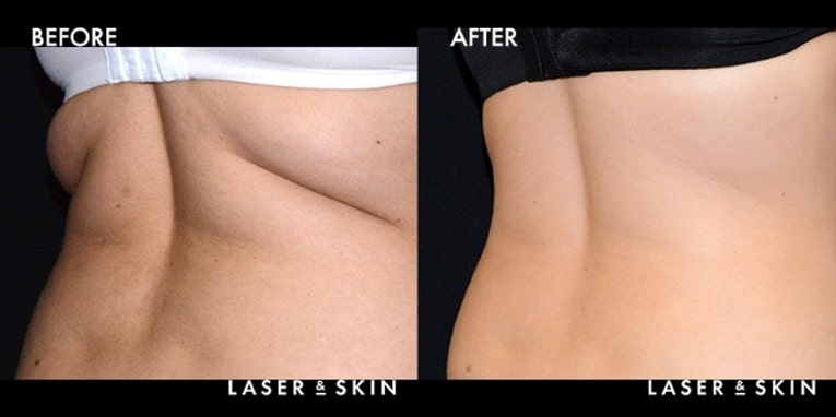 Treatments_BodyContouring-CoolSculpting6-2.jpeg