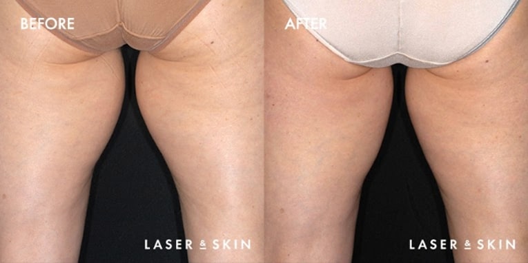 Treatments_BodyContouring-CoolSculpting8-2.jpeg