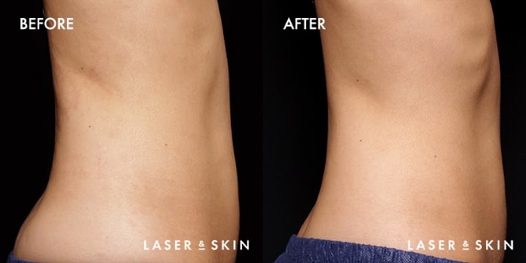 Treatments_BodyContouring-EmSculpt1-2.jpeg