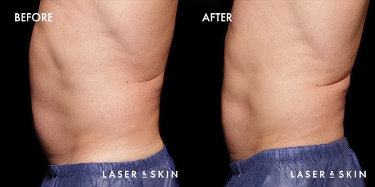 Treatments_BodyContouring-EmSculpt2-2.jpeg