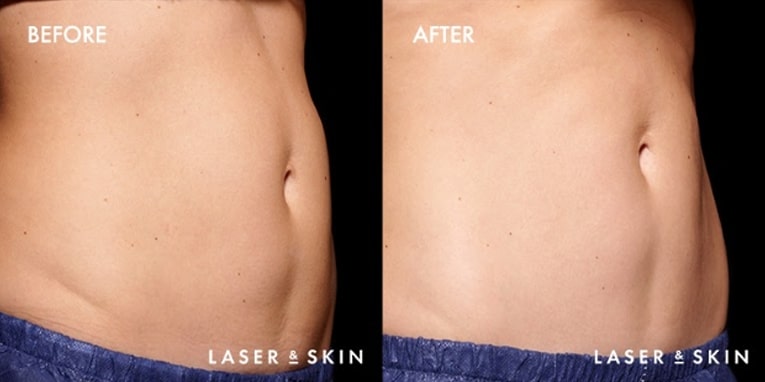 Treatments_BodyContouring-EmSculpt3-2.jpeg