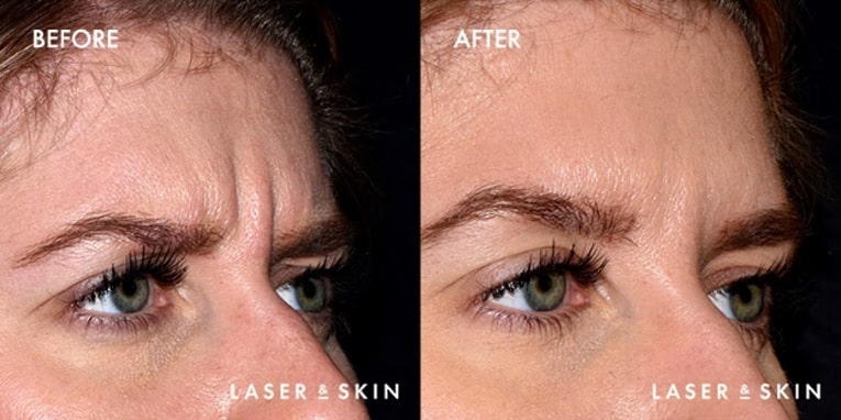 Treatments_Injectables-Botox1-2.jpeg