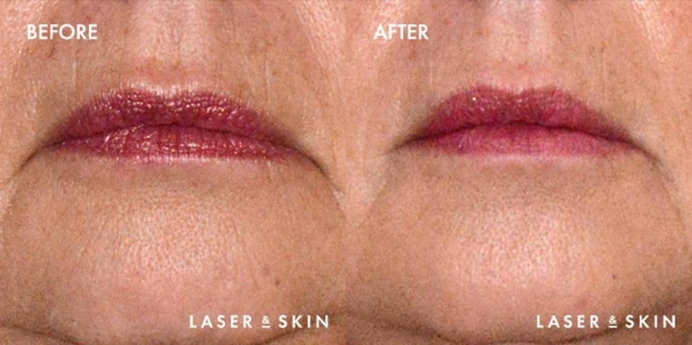 Treatments_Injectables-Botox2-2.jpeg