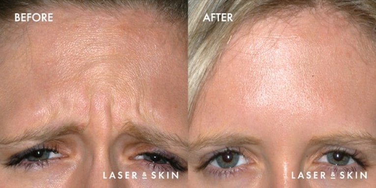 Treatments_Injectables-Botox3-2.jpeg