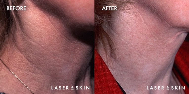 Treatments_LaserDevices-CO2LaserResurfacing1-1.jpeg