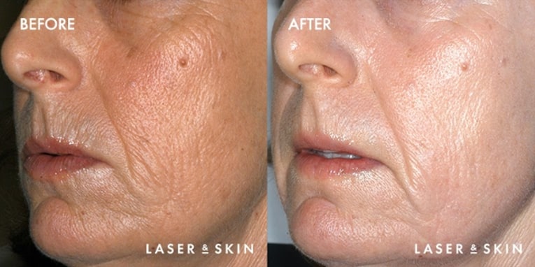 Treatments_LaserDevices-CO2LaserResurfacing2-1.jpeg