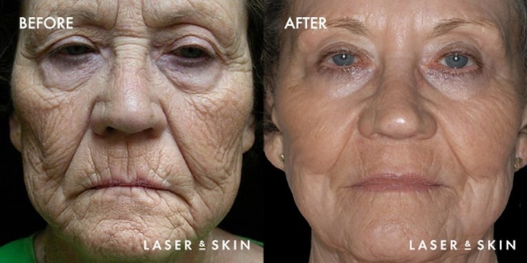 Treatments_LaserDevices-CO2LaserResurfacing3-1.jpeg