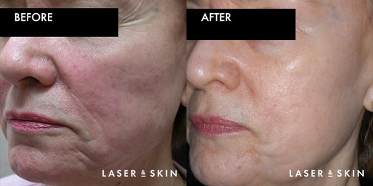 Treatments_LaserDevices-CO2LaserResurfacing4-1.jpeg