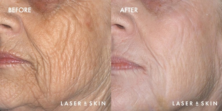 Treatments_LaserDevices-CO2LaserResurfacing5-1.jpeg