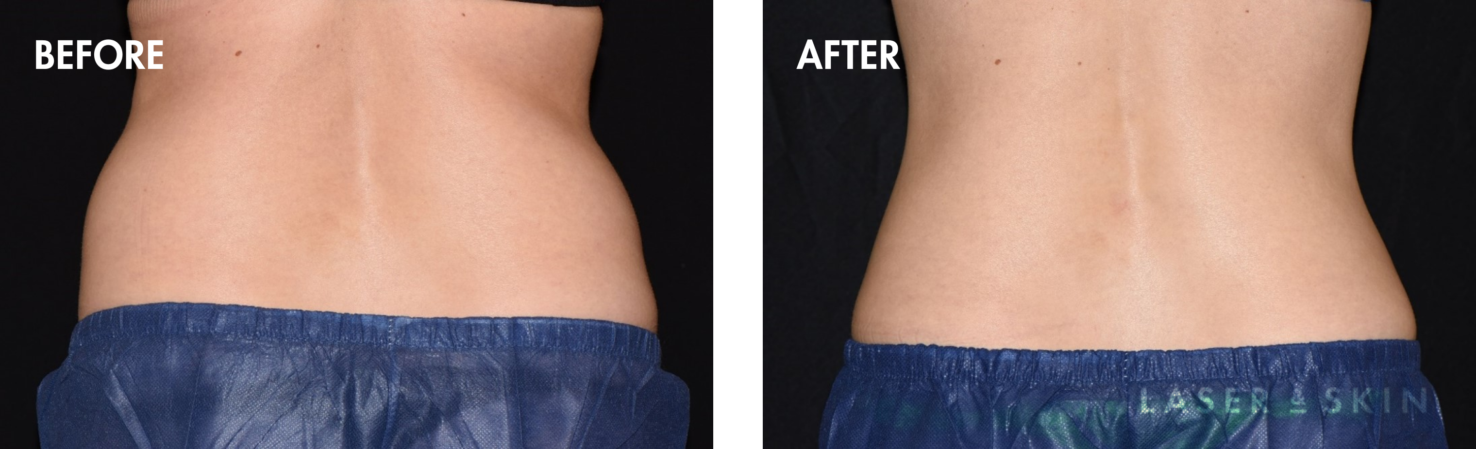 coolsculpting-elite1.png