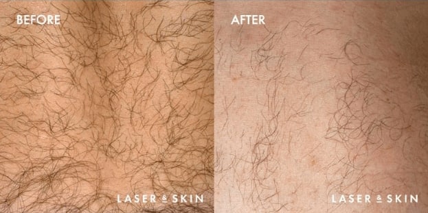 Laser-Hair-Removal-Result-1.jpg