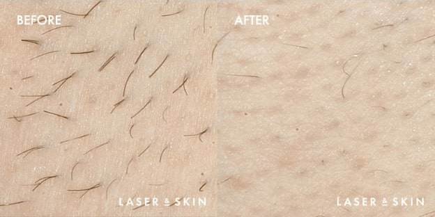 Laser-Hair-Removal-Result-2.jpg