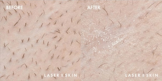 Laser-Hair-Removal-Result-3.jpg