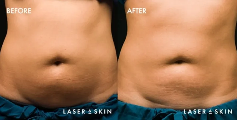 Treatments_BodyContouring-CoolSculpting4.jpeg