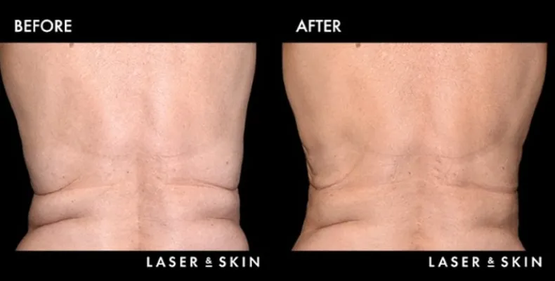 Treatments_BodyContouring-CoolSculpting5.jpeg