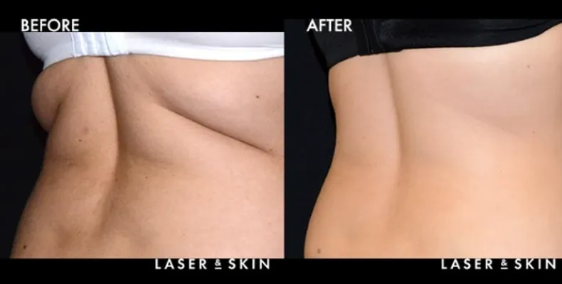 Treatments_BodyContouring-CoolSculpting6.jpeg