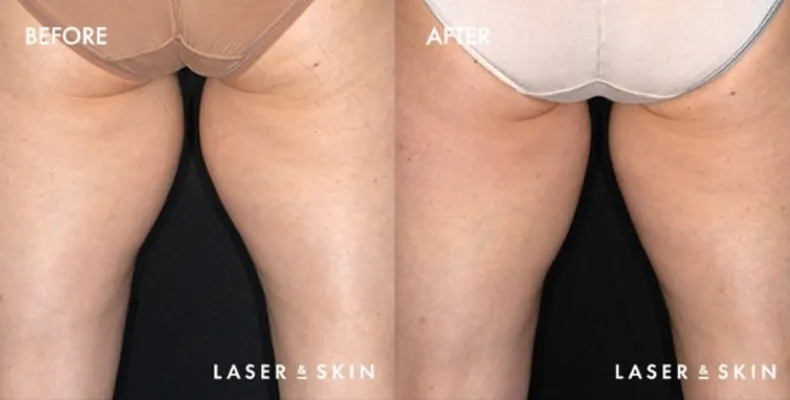 Treatments_BodyContouring-CoolSculpting8.jpeg