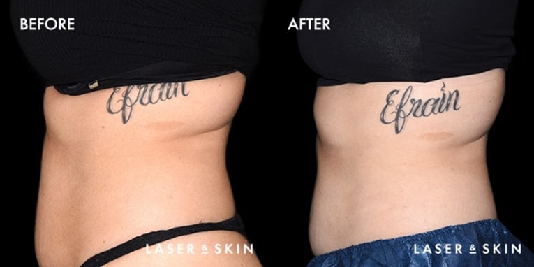 Treatments_BodyContouring-CoolTone1.jpeg