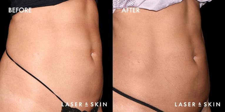 Treatments_BodyContouring-CoolTone3.jpeg