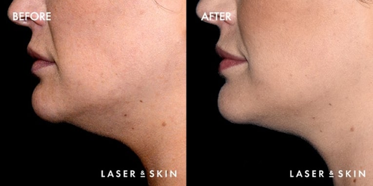 Treatments_BodyContouring-Kybella1-1.jpeg