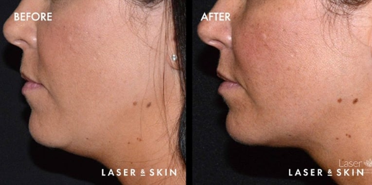 Treatments_BodyContouring-Kybella2-1.jpeg