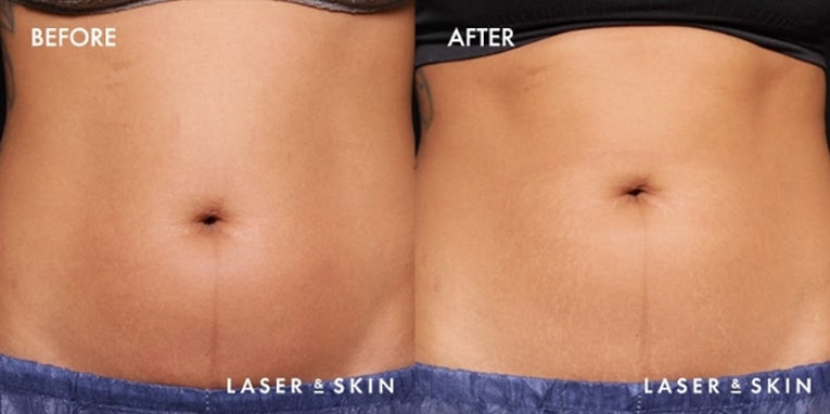 Treatments_BodyContouring-TruSculptID1-2.jpeg