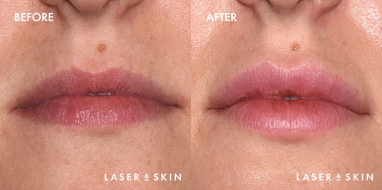 Treatments_Injectables-Juvederm1-1.jpeg