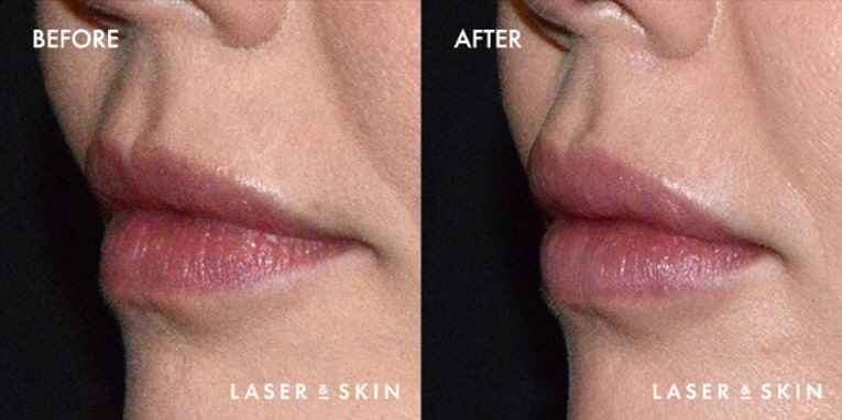 Treatments_Injectables-Juvederm3-1.jpeg