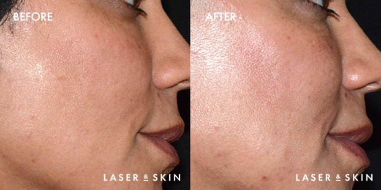 Treatments_Injectables-JuvedermVoluma1-1.jpeg