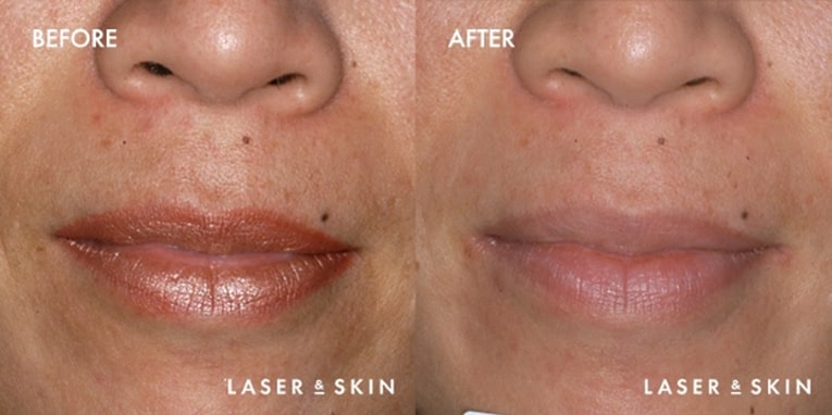 Treatments_Injectables-Restylane1-1.jpeg