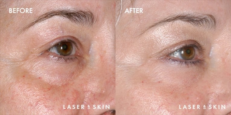 Treatments_Injectables-Restylane2-1.jpeg