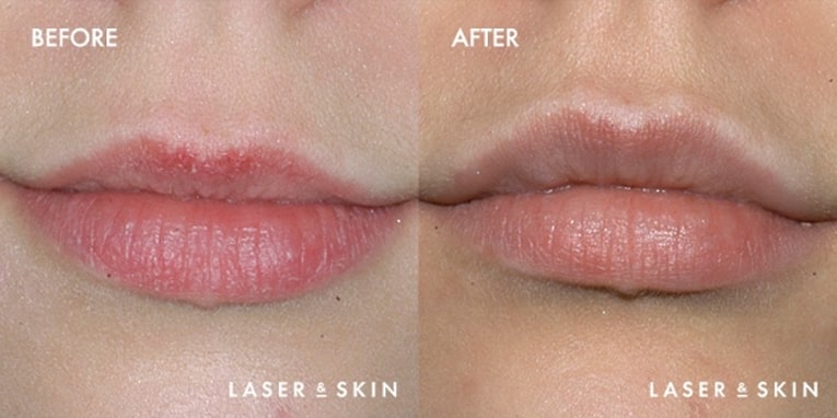 Treatments_Injectables-Restylane3.jpeg