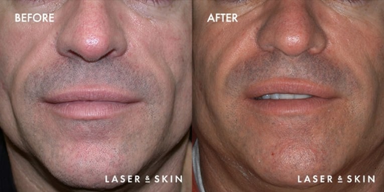 Treatments_Injectables-SculptraAesthetic1-1.jpeg