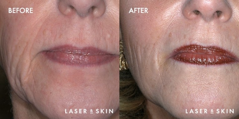 Treatments_Injectables-SculptraAesthetic2-1.jpeg