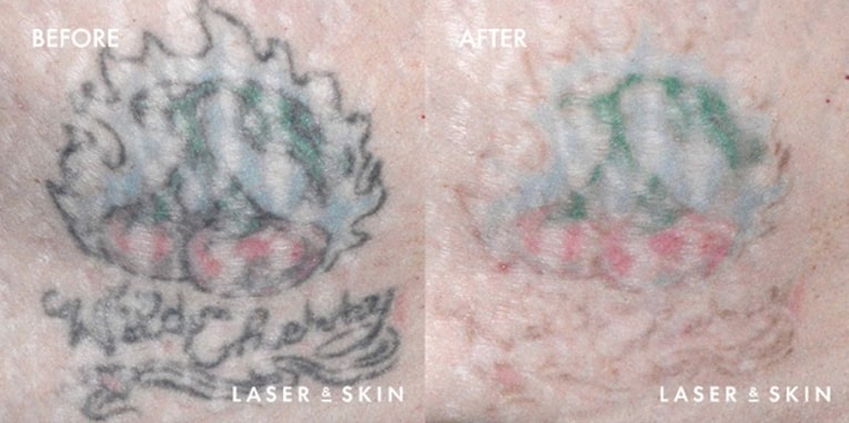 Treatments_LaserDevices-LaserTattooRemoval1-1.jpeg