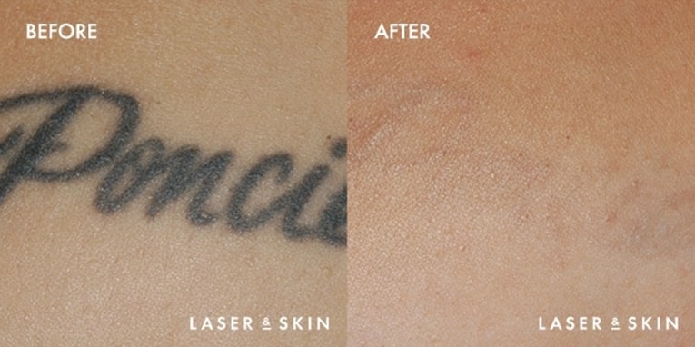 Treatments_LaserDevices-LaserTattooRemoval2-1.jpeg