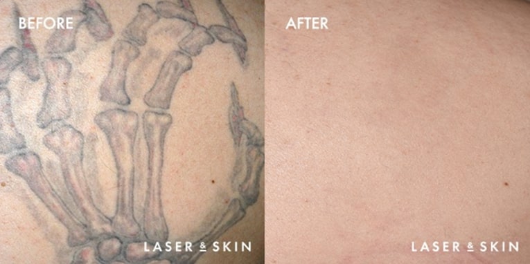 Treatments_LaserDevices-LaserTattooRemoval3-1.jpeg