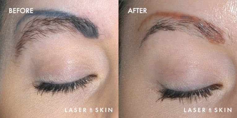 Treatments_LaserDevices-LaserTattooRemoval4-1.jpeg