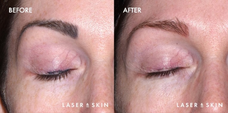 Treatments_LaserDevices-LaserTattooRemoval5.jpeg