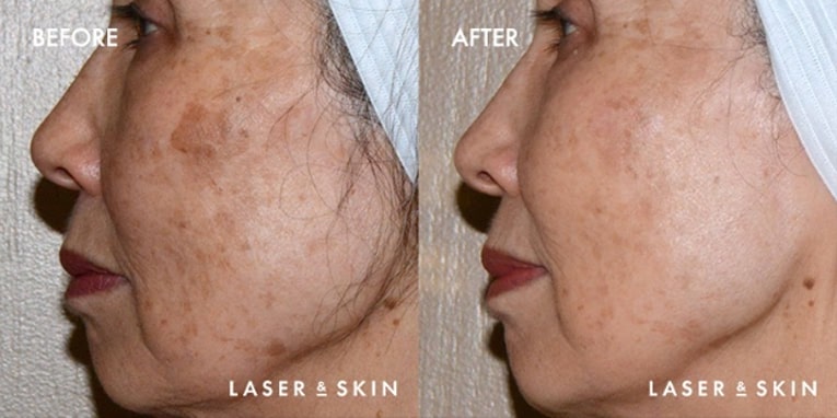 Treatments_LaserDevices-PicoLaserToning1-1.jpeg