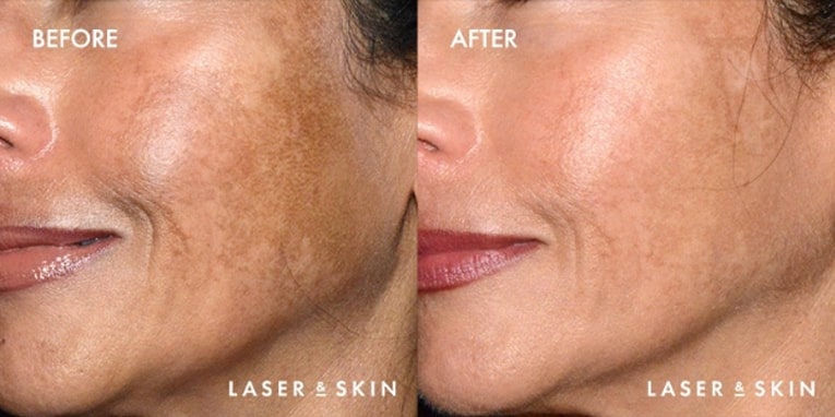 Treatments_LaserDevices-PicoLaserToning2-1.jpeg