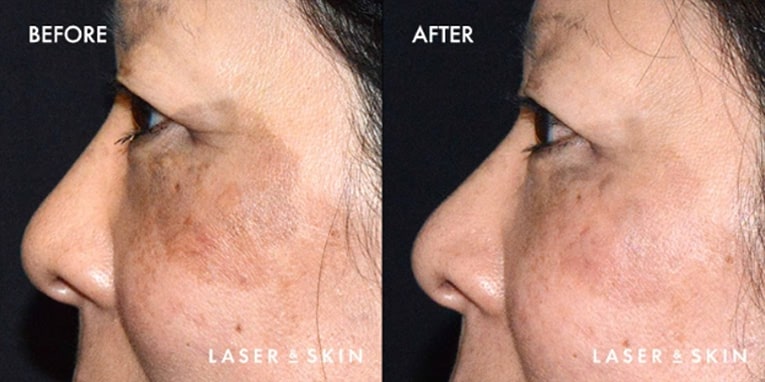 Treatments_LaserDevices-PicoLaserToning3-1.jpeg