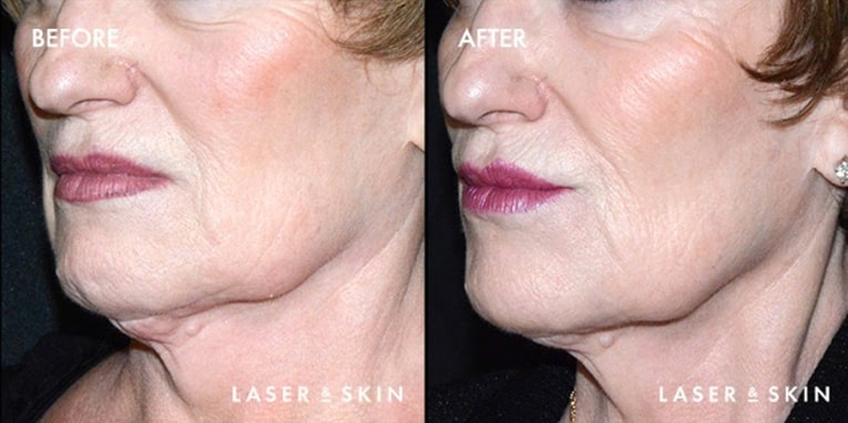 Treatments_LaserDevices-Ultherapy1.jpeg