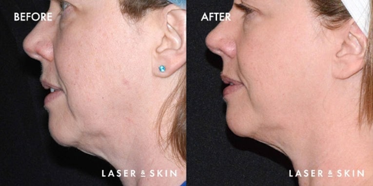 Treatments_LaserDevices-Ultherapy2.jpeg