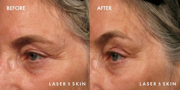 Treatments_LaserDevices-Ultherapy4.jpeg