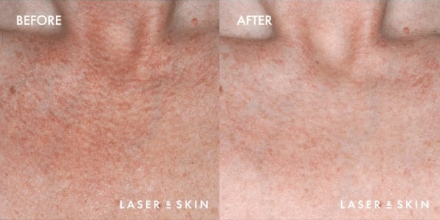 VBeam-Laser-Result-1-1.jpg