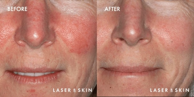 VBeam-Laser-Result-2-1.jpg